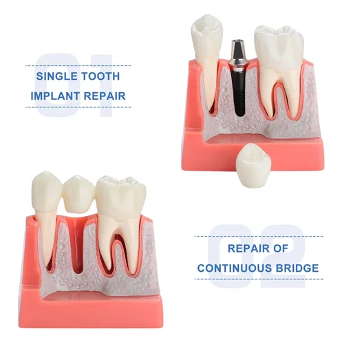 Vista 2 de Modelo de implante dental - Implante Vs Puente Modelo dental 4 veces Análisis extraíble Puente de corona Demostración Modelo de dientes