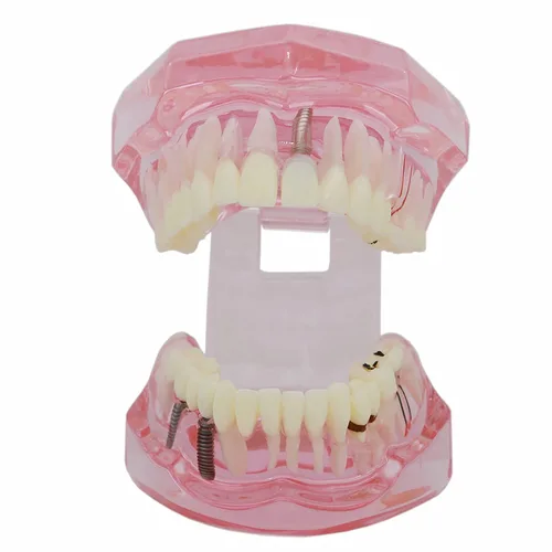 Vista 8 de Modelo de Typodont dental Restauración de implantes Modelo de diente Enfermedad Análisis de patología Dientes Puente Corona Enseñar Estudio