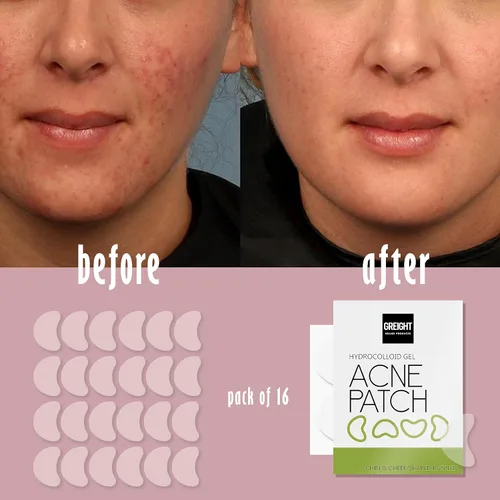 Vista 4 de Parches de espinillas para la cara – (16 unidades) parches de acné hidrocoloide para cubrir granos e imperfecciones y brotes con – vegano, libre