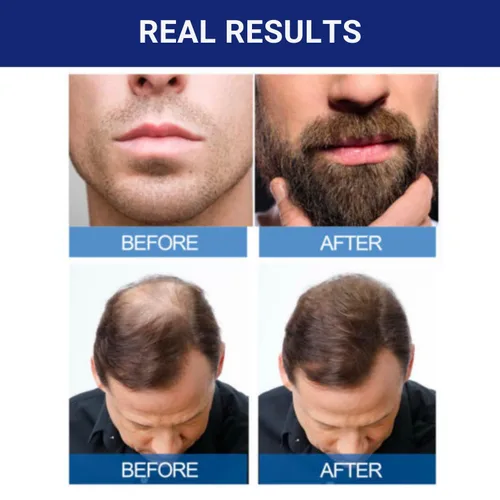 Vista 6 de 5% minoxidil para crecimiento del pelo para hombre de Kirkland Signature, suministro para 1 mes